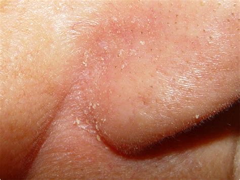 Dermatite Seborreica Conhe A Os Sintomas E A Causa Pronto Atendimento Da Pele Prof S Rgio