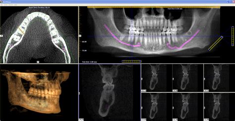 3d Ct Scan Pacific Dental And Implant Solutions