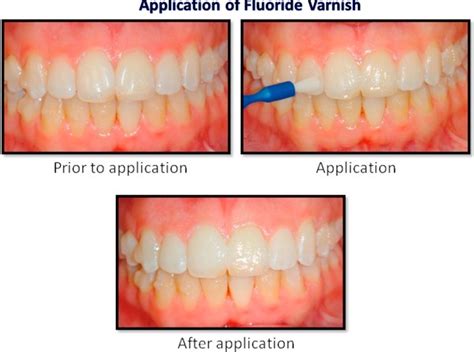 Dental Fluoride Varnish Manik Dental Clinic