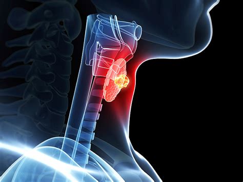 Sub Centimeter Thyroid Nodule Size May Not Offer Good Prognostic