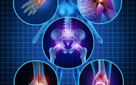 Osteoporosis Risk Factors Paula Owens