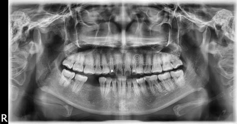 Panoramic Scanning Dental X Ray Of The Upper And Lower Jaw