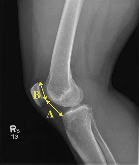 Medial Patellofemoral Ligament Reconstruction For Recurrent Patellar