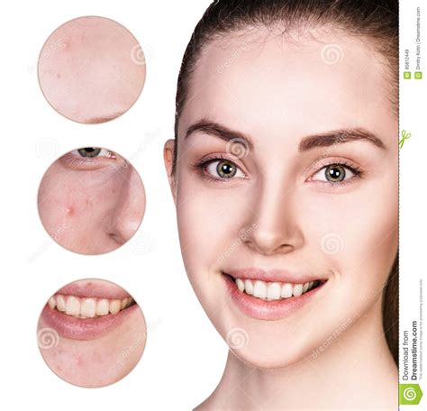 Circles Shows Problem Skin Of Young Woman Stock Image Image Of