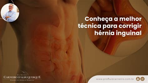 Conheça a melhor técnica para corrigir hérnia inguinal Prof Dr Luiz Carneiro CRM YouTube