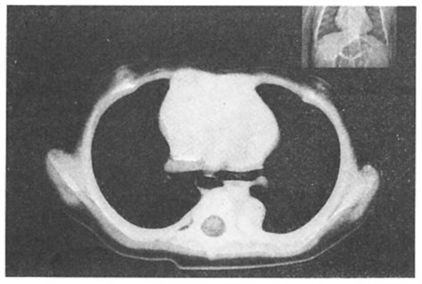Ct Scan Chest Section At The Same Level As Fig I Shows Spontaneous