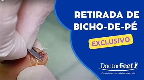 Retirada de Bicho de Pé na Doctor Feet Doctor Feet Podologia