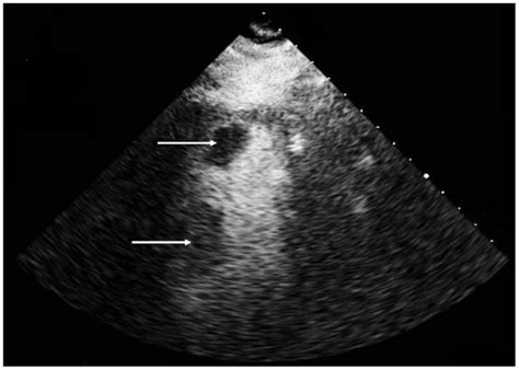 Transthoracic Echocardiogram Apical 2 Chamber View With Contrast