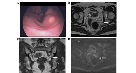 A Case Of Rectal Carcinoid 7 Mm In Diameter With Skip Metastasis To