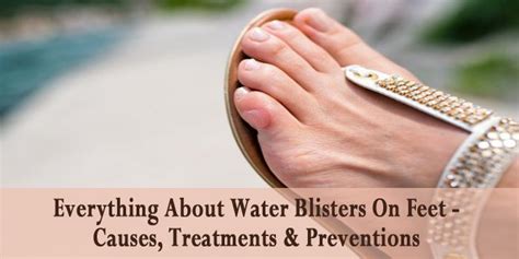 Everything About Water Blisters On Feet Causes Treatments