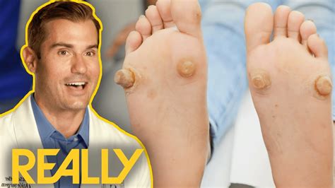 Dr Brad Blown Away By Severe Foot Growths My Feet Are Killing Me YouTube