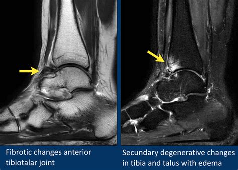 The Radiology Assistant Ankle Mri Examination