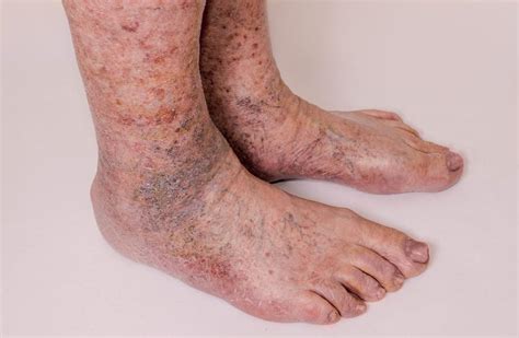 Brown Skin Discoloration On Lower Legs Chronic Venous Insufficiency