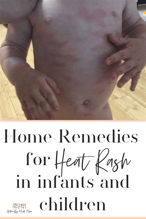 During hot and humid weather condition, adults also get affected by baby heat rash. 5 Best Home Remedies for Baby Heat Rash - Naturally Made Mom