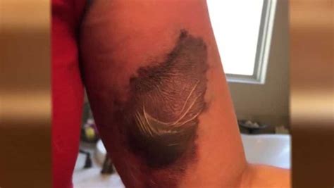 Flesh Eating Bacteria Spikes In Florida After Hurricane Ian