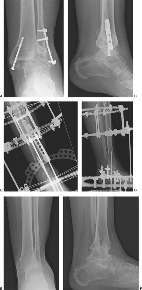 A technique of ankle arthrodesis. Stepwise Approach to Static Circular External Fixation ...