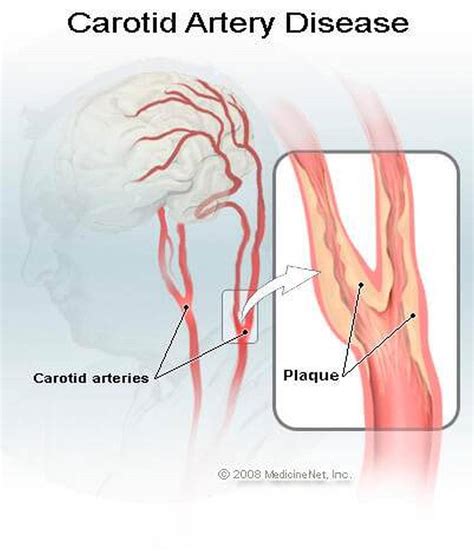 The literature in the trials support the efficacy of embolic protection devices and procedures should not be done without them. Pictures Of Carotid Arteries