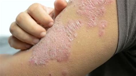 Hands Man Scratching Arm Skin Rash Psoriasis — Stock Video