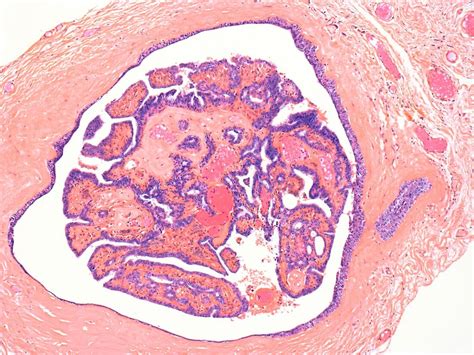 Intraductal Papilloma Light Micrograph Bild Kaufen 11681529 Science
