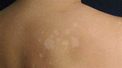 Let's take a look at some of. White Spots From Tanning Causes Home Remedies Otc Treatments