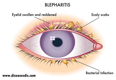 Itchy Eyelids Seborrhoeic Dermatitis Demodex Mites Dry Eyes Relief
