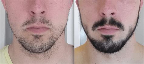 How do you say minoxidil is useful for beard growth.it is clinically not proved and company also not proposed. Good or Bad: Does Rogaine Really Help Grow a Beard?