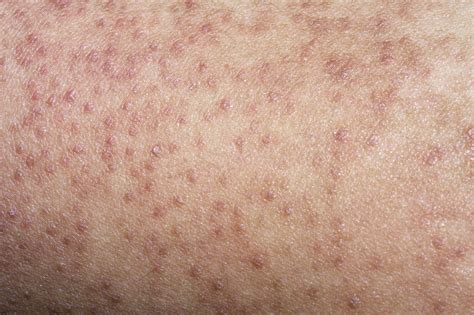 Keratosis Pilaris Nhs