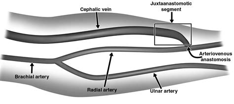 Arteriovenous Fistulas And Their Characteristic Sites Of Stenosis Ajr