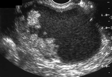 Serous Cystadenoma Ultrasound