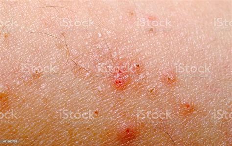 Allergic Rash Dermatitis Skin Stock Photo Download Image Now Istock