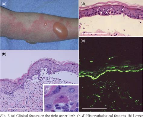 Figure 1 From Detection Of Apoptotic Keratinocytes In A Case Of Bullous