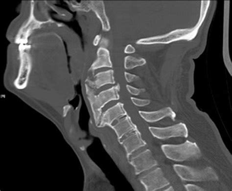 Ct Scan Cervical Spine Axial Images Ct Scan Machine Images And Photos