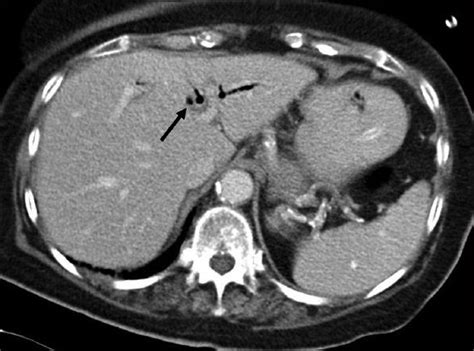 Axial Ct Image Of The Upper Abdomen There Is Diffuse Pneumobilia