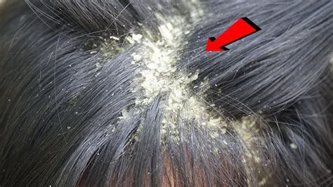 Dandruff Scratching Itchy Dry Scalp Huge Flakes Psoriasis Treatment