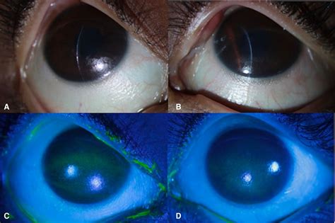 Xerophthalmia Due To Vitamin A Deficiency Following Freys Procedure