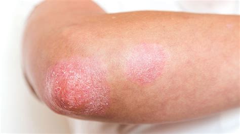 Psoriasis Treatments In Houston Tx Skin Cancer Specialists