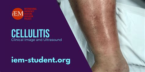 cellulitis clinical image and ultrasound international emergency medicine education project