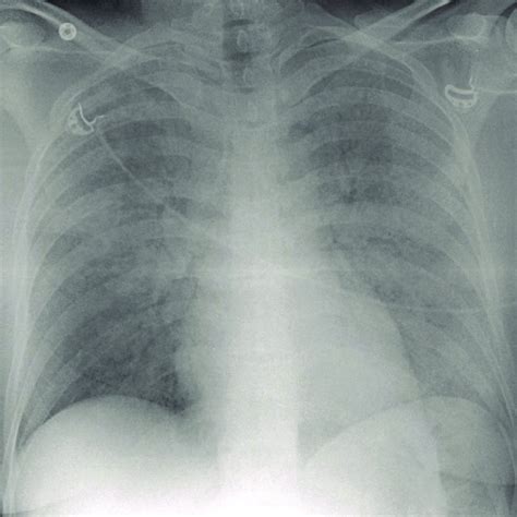 A Chest X Ray Taken On ICU Admission Acute Pulmonary Oedema