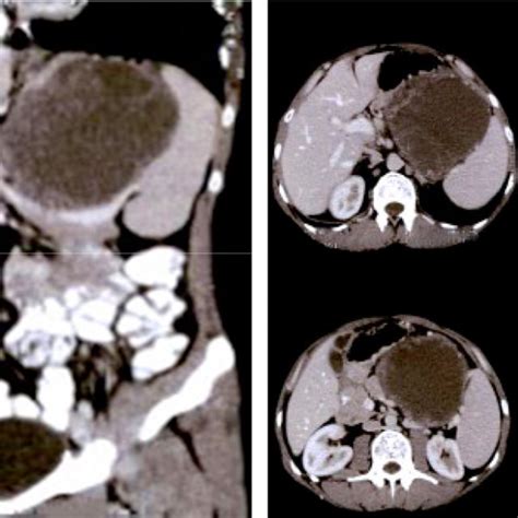 Triphasic Abdominal Ct With Contrast Coronal And Axial View Revealed