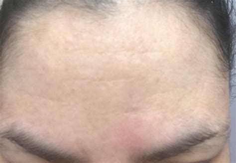 Skin Concerns Small Bumps On Forehead That Are Skin Coloured And Sometimes Turn Red And Itch