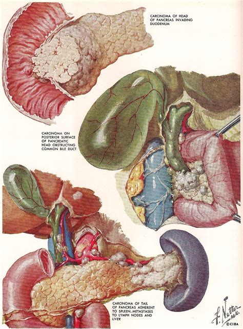The definition of malignant is something evil or intending harm, a tumor that is spreading, or a disease that is invasiv. Malignant Tumors: Carcinoma, Gross Pathology and Clinical ...