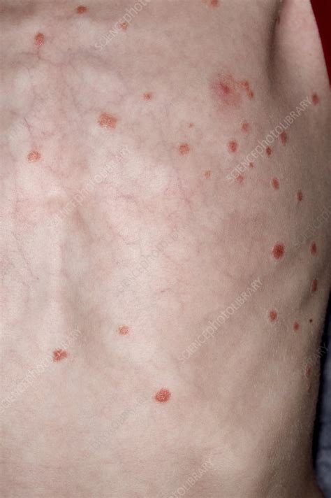 Guttate Psoriasis Stock Image C0199576 Science Photo Library