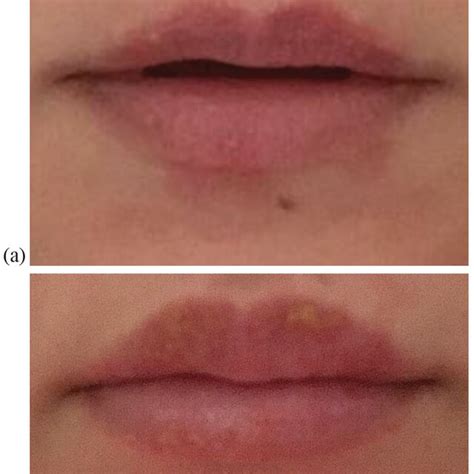 A Edematous Scaly Cutaneous Lip With Microvesicles And A Few