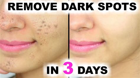How To Remove Dark Patches And Spots From Your Face Maxdio