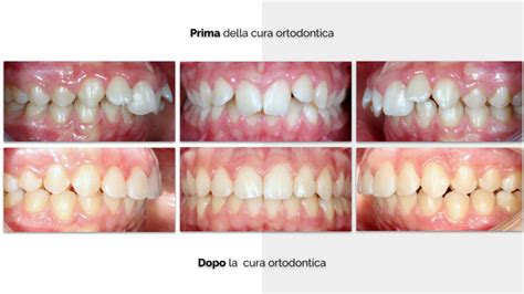 Studio Dentistico Balestro Malocclusione Di II Classe Div 2