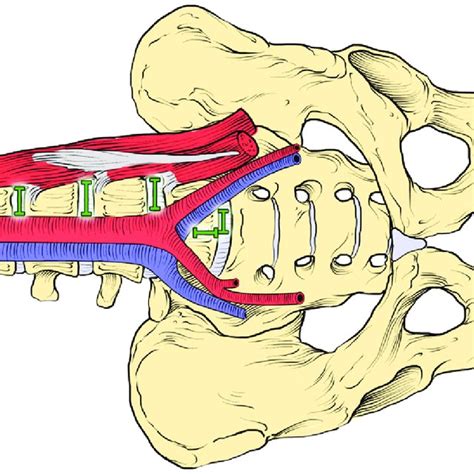 Illustration Of The Oblique Lumbar Interbody Fusion Olif Tech