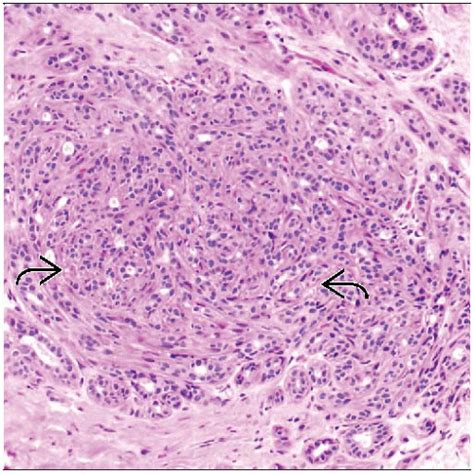 Sclerosing Adenosis Basicmedical Key