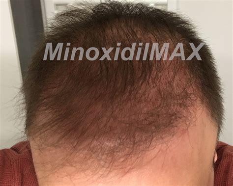 Minoxidil Results Before After Amazing Pictures