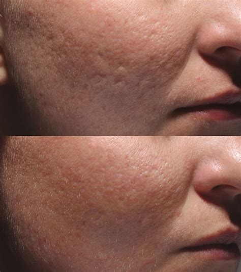 Bellafill Acne Scarring Before And After Photo Lookyoungernews