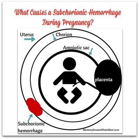 What Causes Subchorionic Hemorrhage In Pregnancy